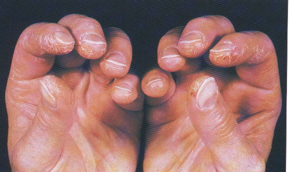 Polymyositis & Dermatmyositis def., diagnosis and treatment ~ Med2Date