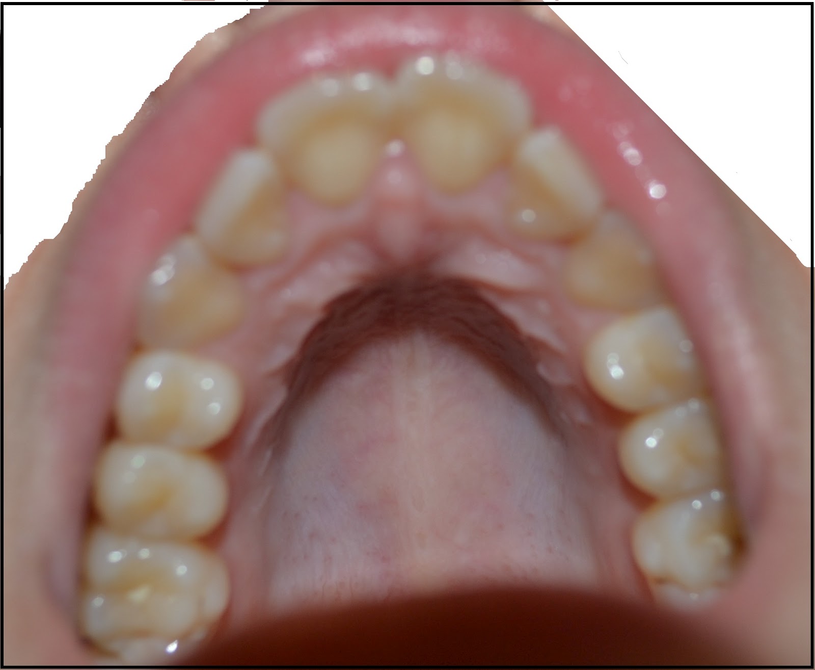 Expérience de Traitement Orthodontique et Chirurgie Maxillo Faciale La première pose de bagues