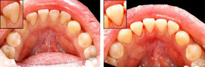 Cạo vôi răng có đau không? 