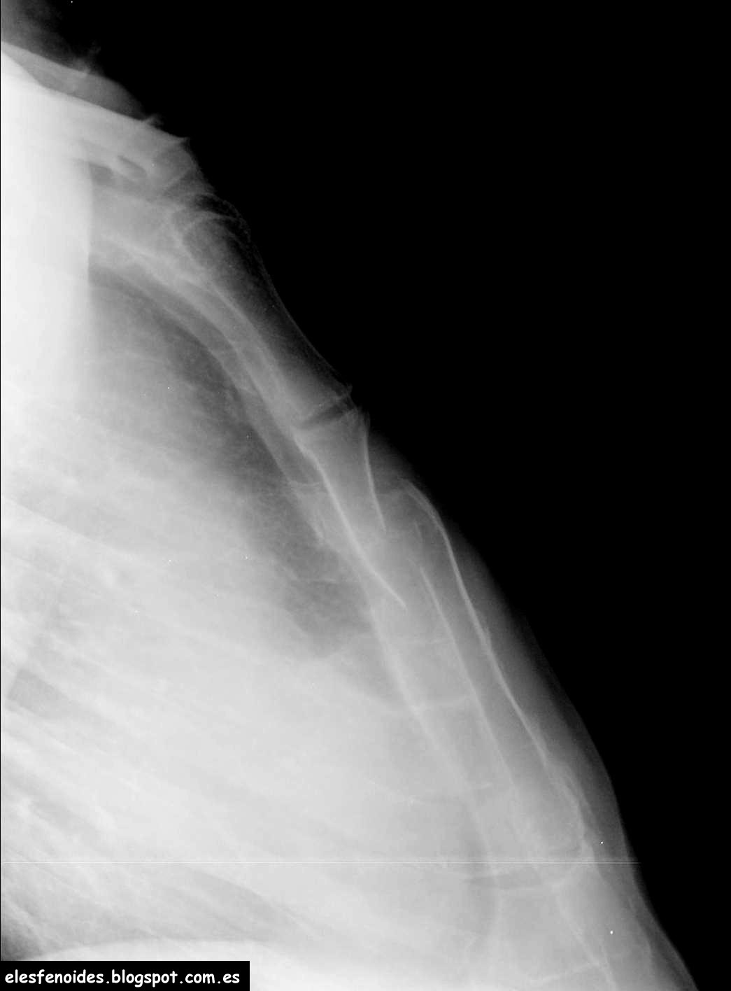 El esfenoides: Fractura de esternón. 2 imágenes 1 caso.