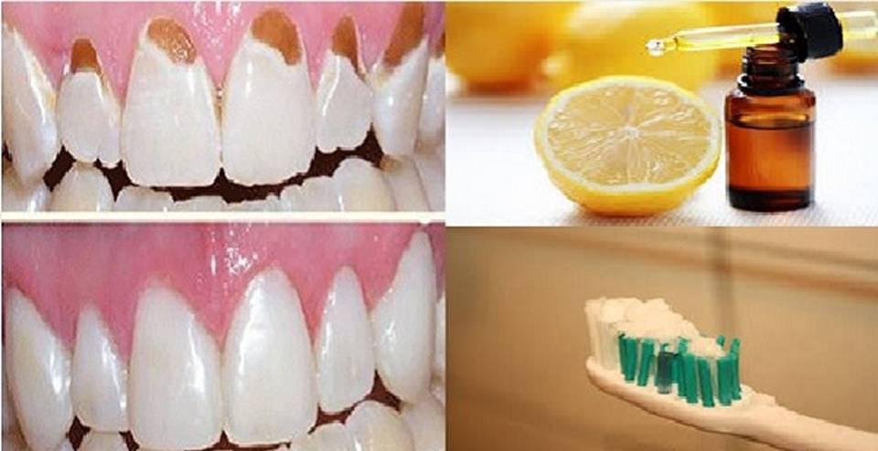 Prevent Tooth Decay, Protect Your Enamel And Make Your
