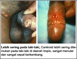 obat sifilis untuk wanita, apa obat alami penyakit sipilis, jual obat sipilis raja singa super