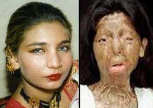 Mujer pakistaní desfigurada con ácido por su esposo musulmán