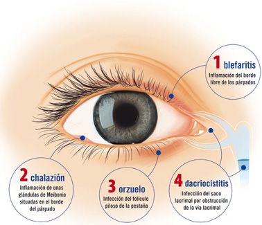 manejo orzuelo