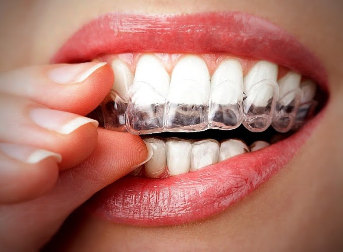ORTODONCIA INVISIBLE: Una ortodoncia estética, cómoda y transparente