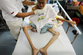 44+ Koleksi Populer Gambar Orang Aids