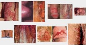 Obat Sipilis Asli Super Tetra Obat Sipilis Asli Super Tetra