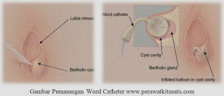 word catheter