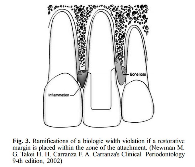 PDF: Surgical lengthening of the clinical tooth crown
