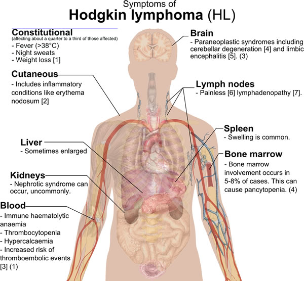 Symtoms of Hodgkin lymphoma