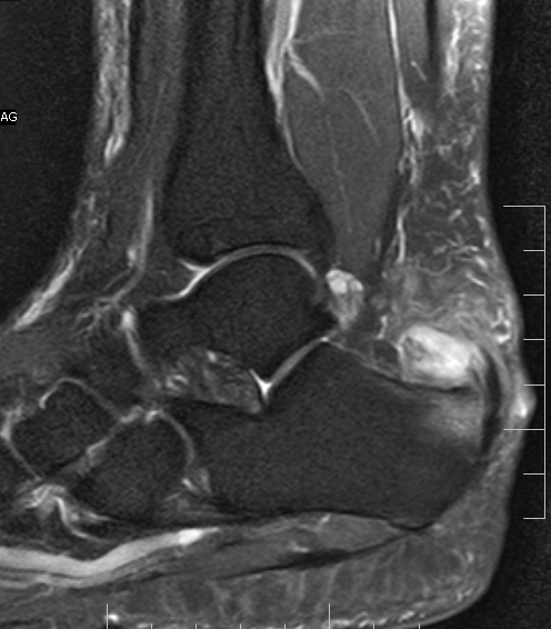 Mri Shows Mid Foot Edema 23