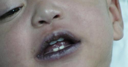 Pediatrics Notes: A Child Presenting With Cyanosis – Differential Diagnosis