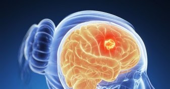 ТОДИКАМП: ЭКСТРАКТ ТОДИКАМП® И ОПУХОЛЬ МОЗГА