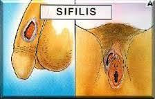 Image Penyebab berengan atau luka di area bibir vagina