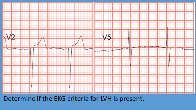Telemetry Technician Course: EKG Criteria for Left Ventricular ...