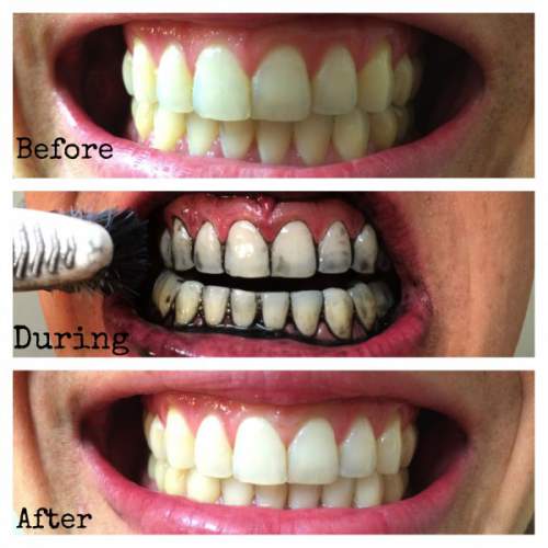 cara memutihkan gigi secara alami dengan cepat 5 Cara Memutihkan Gigi yang Kuning dengan Cepat Secara Alami