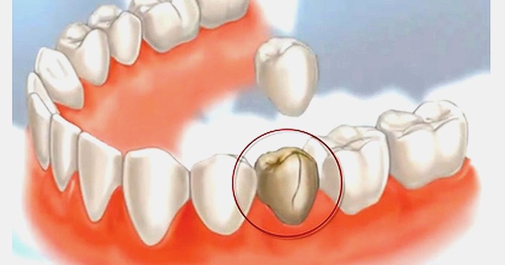 What to Do if You Have a Chipped or Broken Crown Directorio Odontológico