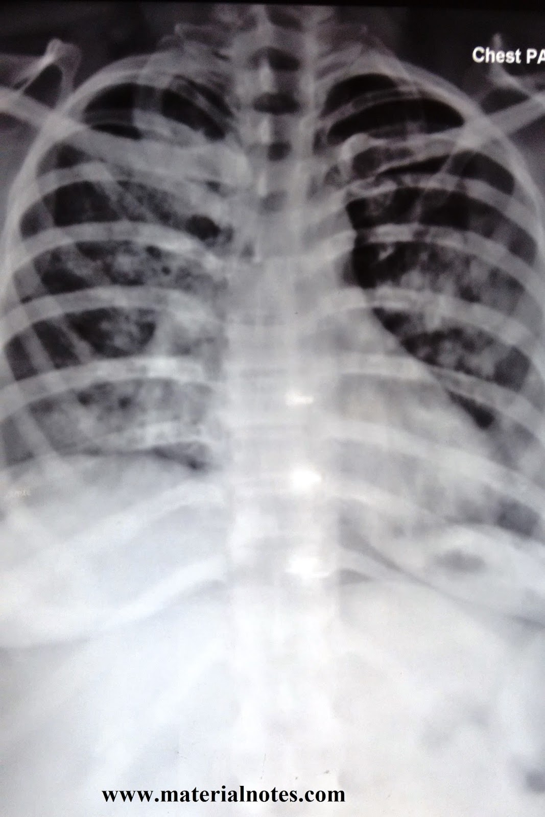Tuberculosis Chest Xray Staff Nurses in India