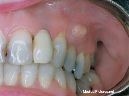 www.BestOgdenDentist.com Blog: Do I have an abscessed tooth?