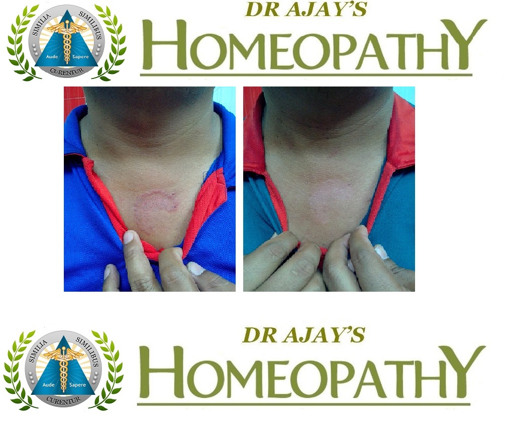 Dr Ajays Homeopathy Homeopathy is Best for Recurrent Fungal