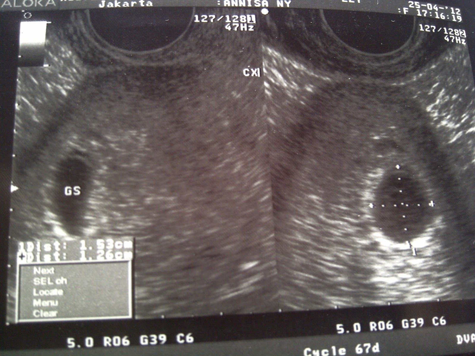Gambar Hasil Usg Janin Perempuan : Dahlia Poland Bahagia Unggah Hasil