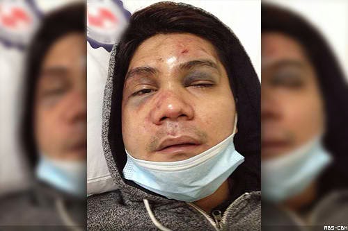 Vhong Navarro condition after brutal attack