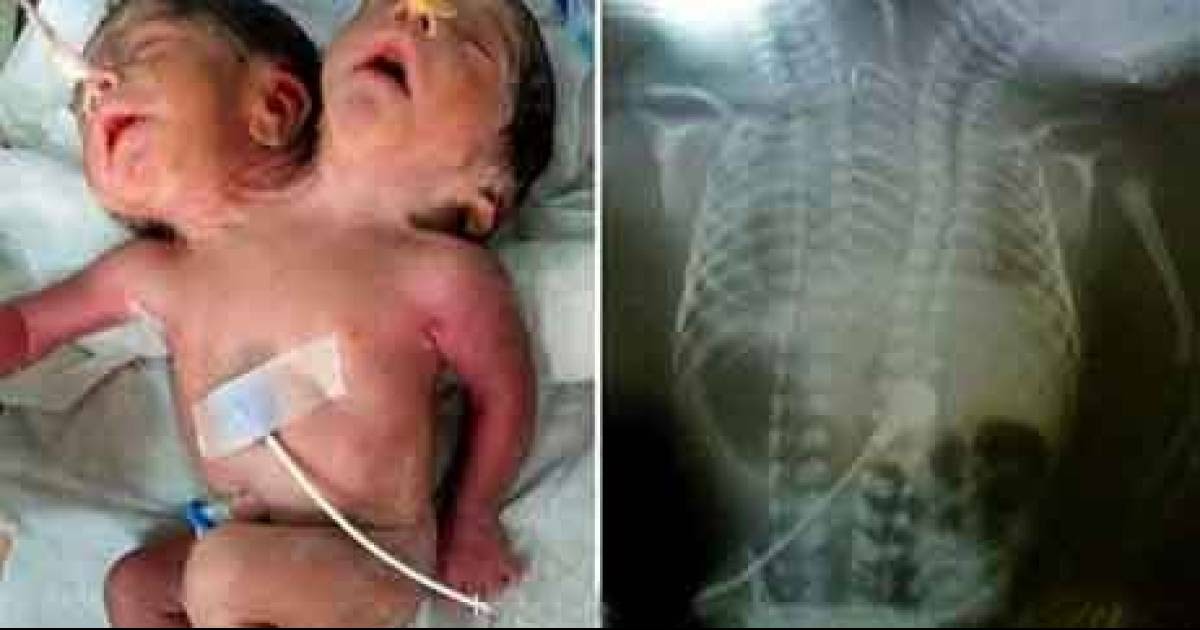 TwoHeaded Baby Boy Born In India CrazePortal