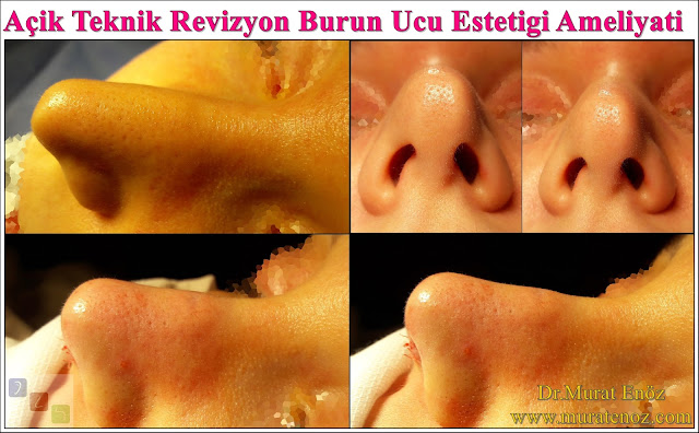 Open technique nose tip plasty - Tip plasty in Istanbul - Tip plasty in Turkey - Revision tipplasty in Istanbul  -  Revision tipplasty in Turkey - Unilateral transdomal suture - Tip rhinoplasty in Istanbul - Open technique nose tip surgery