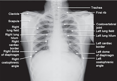 Study Medical Photos: Simplified Approach To Reading Chest X- Rays.