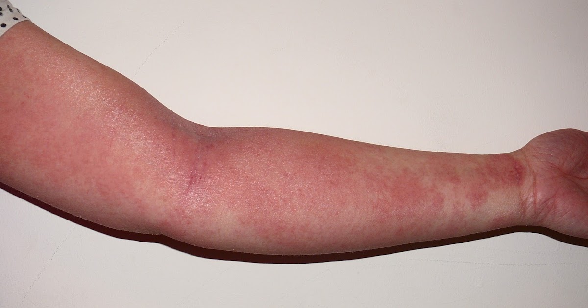 Zmiany Odczynowe Związane Z Zapaleniem łącznie Z Typową Regeneracją Życie z Atopowym Zapaleniem Skóry