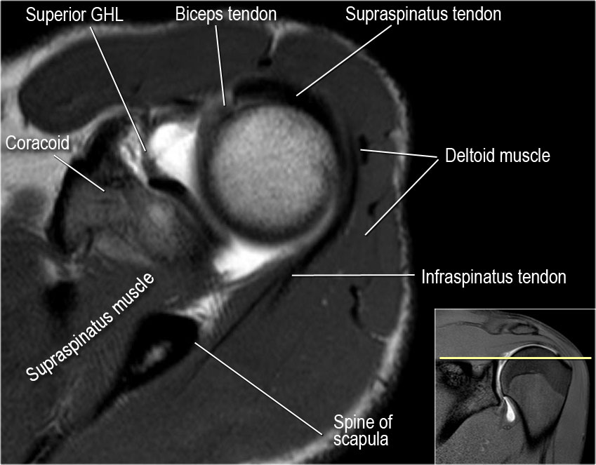 MRI Musculo-Skeletal Section: How to locate glenohumeral ligaments.