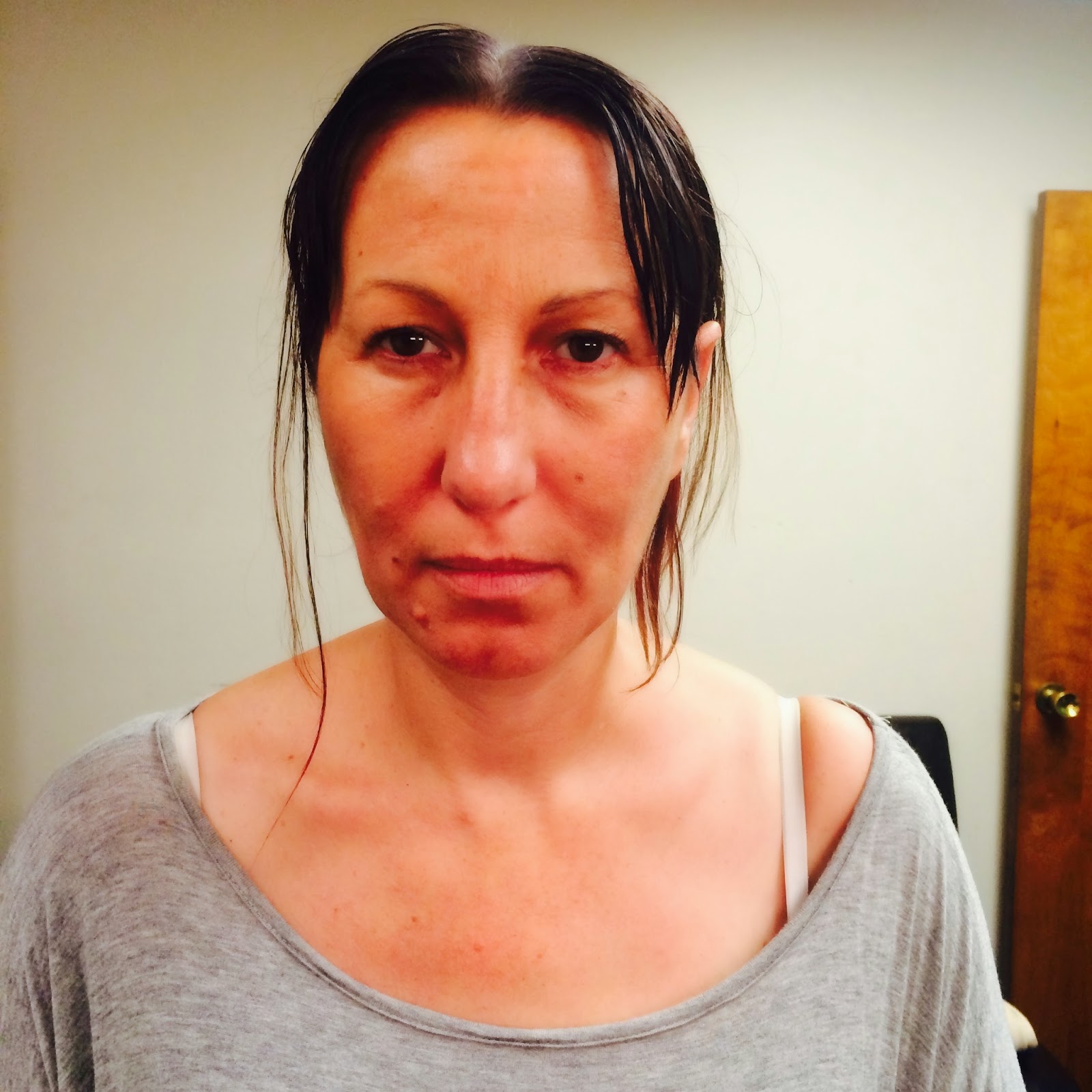 Dermaplaning Before After Pictures The Ultimate Skincare Makeover - wqn8rgn