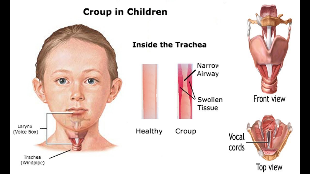How to treat false croup in a child How to treat false croup in a child