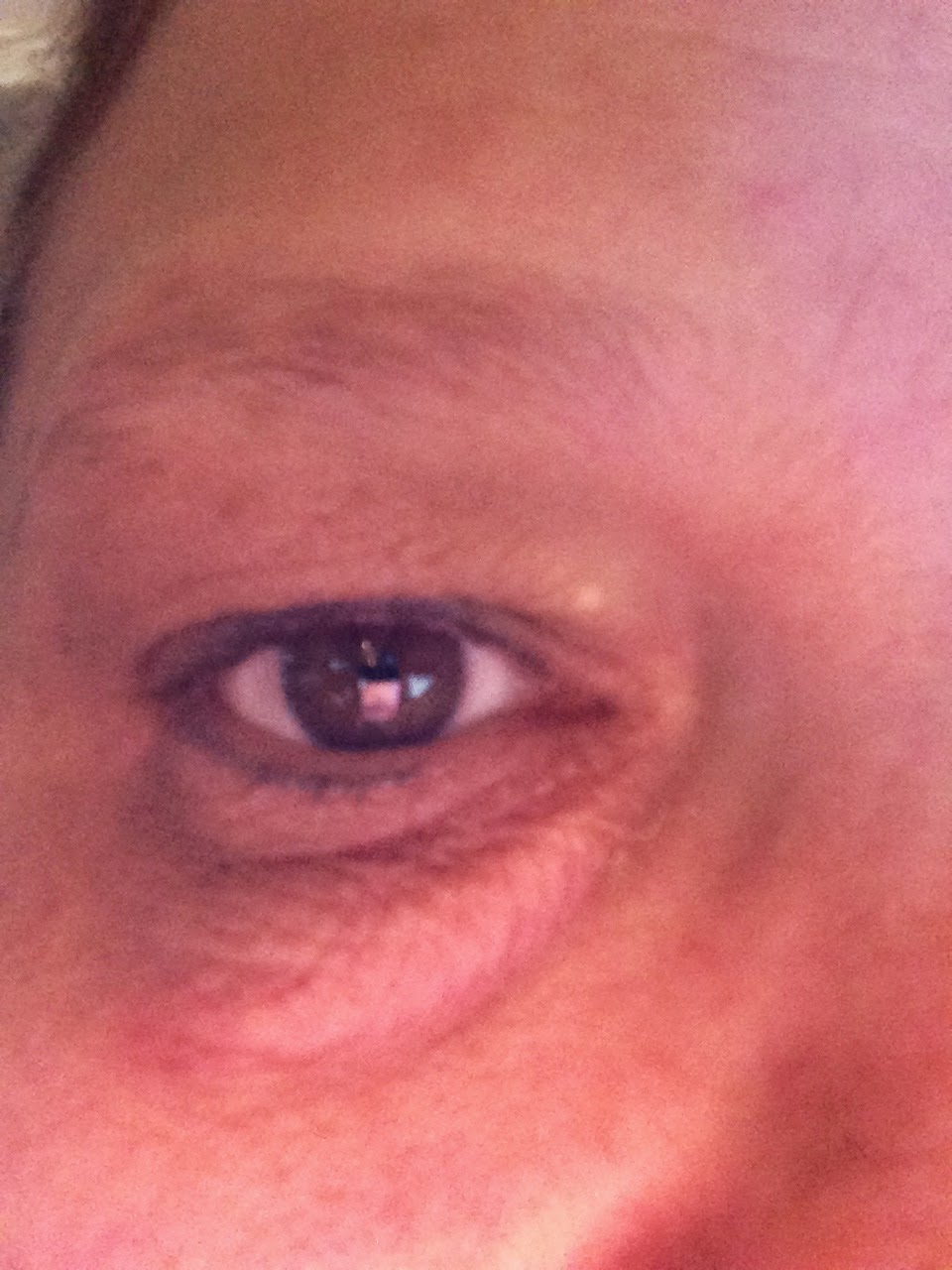 Xanthelasma Garlic Treatment.. With pictures! Xanthelasma Garlic