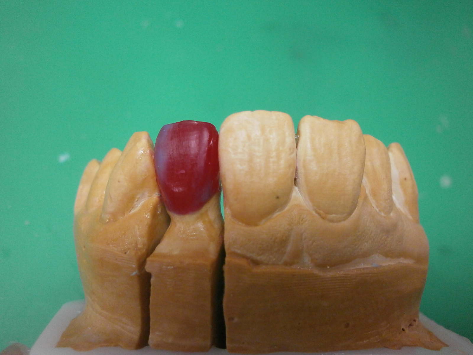 髙田朝（Hajime Takada）のオーダーメイド歯科技工物の紹介 Introduction of custommade dental