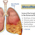 Symptoms of pleural mesothelioma (mesothelioma of the chest) can include