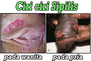 Cara Mengobati Penyakit Sifilis dengan Khasiat Belimbing Manis dan Alpukat