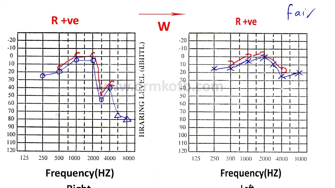 Acoustic Neuroma Hearing Loss Hear Choices