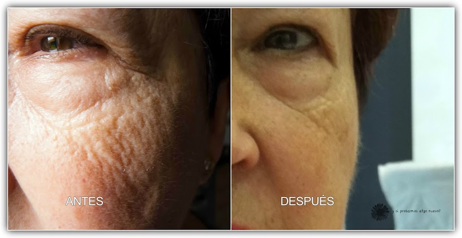 Revitalift laser x3 de L´Oréal