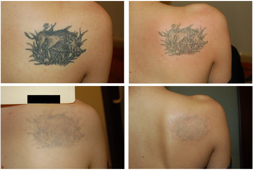 1. Laser Tattoo Removal for Neck Tattoos - wide 3