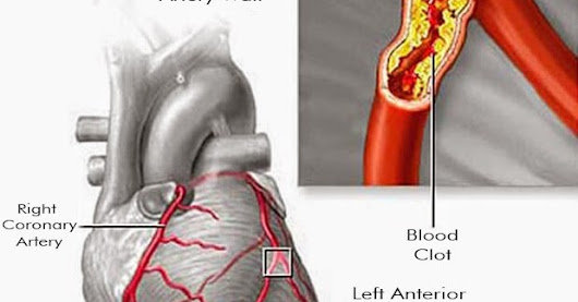 Clogged Arteries Can Harm Your Brain And Kidneys: Clean Them With Just 3 Ingredients