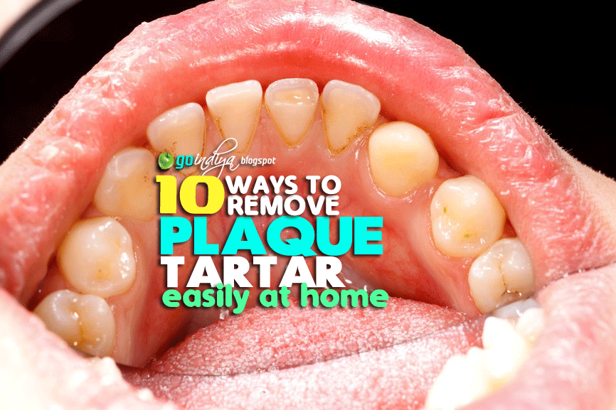 10 Easy Ways To Remove Plaque And Tartar From Teeth At Home Naturally 10-easy-ways-to-remove-plaque-and-tartar-from-teeth-at-home-naturally