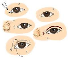 Phẫu thuật mở rộng góc mắt hiện được coi là giải pháp làm đẹp tối ưu