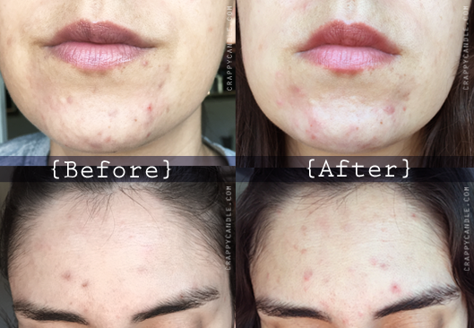 Lactic Acid Exfoliant Before & After - The Acne Experiment