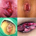 Obat Salep Antiradang Untuk Benjolan Wasir thumbnail
