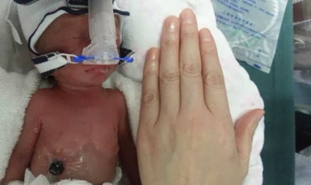 Bayi Kembar Lahir Satu Prematur Seukuran Tapak Tangan