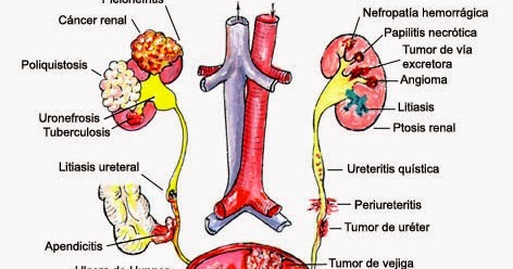 hematuria gross prostate causes treatment surgery cancer india enlarged
