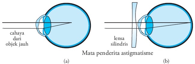 hipermetropie de astigmatism cum să reveniți la vedere