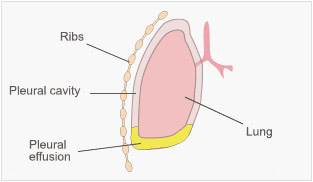 Pleural Mesothelioma Pleural Mesothelioma