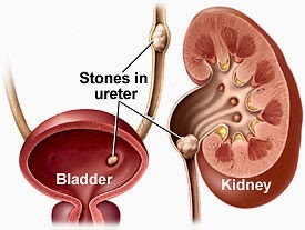  Kidney-Renal Stones   The kidney acts as a filter for blood, removing waste products from the body and helping regulate the levels of chemicals important for body function. The urine drains from the kidney into the  Bladder through a narrow tube called the ureter. When the bladder fills and there is an urge to urinate, the bladder empties through the urethra, a much wider tube than the urethra.  In some people, the urine chemicals crystallize and form the beginning, or a nidus, of a kidney stone. These stones are very tiny when they form, smaller than a grain of sand, but gradually they can grow to a quarter inch or larger. The size of the stone doesn't matter as much as where it is located. When the stone sits in the kidney, it rarely causes problems, but should it fall into the ureter, it acts like a dam. The kidney continues to function and make urine, which backs up behind the stone, stretching the kidney. This pressure build up causes the pain of a kidney stone, but it also helps push the stone along the course of the ureter. When the stone enters the bladder, the obstruction in the ureter is relieved and the symptoms of a kidney stone are resolved.   Kidney-renal Stones Causes There is no consensus as to why kidney stones form.  • Heredity: Some people are more susceptible to forming kidney stones, and heredity certainly plays a role. The majority of kidney stones are made of calcium, and hypercalciuria (high levels of calcium in the urine), is a risk factor. The predisposition to high levels of calcium in the urine may be passed on from generation to generation. Some rare hereditary diseases also predisposecystine (an amino acid), oxalate, (a type of salt), and uric acid (as in gout).  some people to form kidney stones. Examples include people with renal tubular acidosis and people with problems metabolizing a variety of chemicals including • Geographical location: There is also a geographic predisposition in some people who form kidney stones. There are regional "stone belts," with people living in the Southern United States, having an increased risk. This is likely because of the hot climate, since these people can get dehydrated, and their urine becomes more concentrated, allowing chemicals to come in closer contact and begin forming the nidus of a stone. • Diet: Diet may or may not be an issue. If a person is susceptible to forming stones, then foods high in calcium may increase the risk, however if a person isn't susceptible to forming stones, nothing in the diet will change that risk. • OTC products: People taking diuretics (or "water pills") and those who consume excess calcium-containing antacids can increase the amount of calcium in their urine and increase their risk of forming stones. Patients with HIV who take the medication indinavir (Crixivan) can form indinavir stones.   Kidney-Renal  Stones Symptoms When a tubular structure is blocked in the body, pain is generated in waves as the body tries to unblock the obstruction. These waves of pain are called colic.  • Renal colic (renal is the medical term for things related to the kidney) has a classic presentation when a kidney stone is being passed. o The pain is intense and comes on suddenly. o It is usually located in the flank or the side of the mid back and radiates to the groin. Those affected cannot find a comfortable position, and many writhe in pain. o This is opposed to non-colicky type pain, like appendicitis or pancreatitis, where movement causes increased pain and affected persons hold very still. • Sweating, nausea and vomiting are common. • Blood may be visible in the urine because the stone has irritated the ureter. Blood in the urine, however, does not always mean a person has a kidney stone. There may be other reasons for the blood, including kidney and bladder infections, trauma, or tumors. Urinalysis with a microscope may detect blood even if it is not appreciated by the naked eye. Sometimes, if the stone causes complete obstruction, there may be no blood in the urine because it cannot get past the stone.   Investigations • The classic presentation of renal colic associated with blood in the urine suggests the diagnosis of kidney stone. Unfortunately, many other conditions can mimic this disease, and the physician or healthcare provider may need to order tests to confirm the diagnosis. There should always be a concern about the possibility of a leaking abdominal aortic aneurysm when dealing with a patient who presents with the typical symptoms of a kidney stone. • Physical examination is not very helpful in patients with kidney stones, aside from the finding of flank (side of the body between the ribs and hips) tenderness. The examination is often directed to ensuring that other potentially dangerous diagnoses don't exist. As examples, when examining the abdomen, the physician will be looking for a palpable mass that pulsates, which may be a sign of an aneurysm. Tenderness under the right rib cage margin may signal gallbladder disease. • Symptom control is very important, and medication for pain and nausea may be provided before the confirmation of the diagnosis occurs. • A urinalysis will show whether there is blood in the urine. It is also done to ensure that there is no infection associated with the kidney stone. • Blood tests are usually not done, except when the physician has concerns about the diagnosis or is worried about kidney stone complications. • CT scanning of the abdomen is the diagnostic test of choice. It is done without asking the patient to drink contrast material to outline the bowel and without intravenous dye injection. The scan will show the anatomy of the kidneys, ureter, and bladder and will show if a stone exists, how big it is, and how much blockage it is causing. The CT also demonstrates many other organs in the abdomen, like the appendix, pancreas, and aorta and may give extra information in case the preliminary diagnosis of kidney stone was wrong. • Ultrasound is another way of looking for kidney stones and obstruction and may be useful when the radiation risk of a CT scan is unwanted (for example, if a woman is pregnant). • In those patients who already have the diagnosis of a kidney stone, plain abdominal x-rays may be used to track its movement down the ureter toward the bladder.   Complications • Since most patients have two kidneys, a temporary obstruction of one is not of great significance. For those patients with only one kidney, an obstructing stone can be a true emergency, and the need to relieve the obstruction becomes greater. A kidney that remains completely obstructed for a prolonged period of time may stop working. • Infection associated with an obstructing stone is another emergent situation. When urine is infected and cannot drain, it acts like an abscess and can spread the infection throughout the body (sepsis). Fever is a major sign of this complication, but urinalysis may show an infection and cause the urologist to act to place a stent or remove the stone.   Follow-up • For the first-time kidney stone patient, there should be an attempt to catch the stone by straining the urine, so that it can be sent for analysis. The stone may be so tiny that it may not be recognized. While most stones are made of calcium oxalate, should that not be the case, knowing what type of stone is the culprit may be helpful in preventing further episodes. For those whose stone disease is recurrent and the kind of stone is known, this instruction is omitted. • Drinking plenty of water will help push the stone down the ureter to the bladder and hasten its elimination. • A follow-up visit with a urologist will be arranged one to two weeks after the initial visit, allowing the stone to pass on its own. • Patients should call their physician or return to the emergency department if the pain medication is not working to control the pain, if there is persistent vomiting, or if a fever occurs.   How to Prevent Renal stones • While kidney stones and renal colic probably cannot be prevented, the risk of forming a stone can be minimized by avoiding dehydration. Keeping the urine dilute will not allow the chemical crystals to come out of solution and form the nidus of a stone. Making certain that the urine remains clear and not concentrated (yellow) will help minimize stone formation. • Medication may be prescribed for certain types of stones, and compliance with taking the medication is a must to reduce the risk of future stone episodes.   Homoeopathic medical treatment Symptomatic Homeopathy works well for Kidney Stones, It helps to prevent further recurrence also. So its good to consult a experienced Homeopathy physician without any hesitation.  For More details  Please contact   Whom to contact for Treatment  Dr.Senthil Kumar Treats many cases of all types of      In his medical professional experience with successful results. Many patients get relief after taking treatment from Dr.Senthil Kumar.  Dr.Senthil Kumar visits Chennai at Vivekanantha Homeopathy Clinic, Velachery, Chennai 42. To get appointment please call 9786901830, +91 94430 54168 or mail to consult.ur.dr@gmail.com,    For more details & Consultation Feel free to contact us. Vivekanantha Clinic Consultation Champers at Chennai:- 9786901830  Panruti:- 9443054168  Pondicherry:- 9865212055 (Camp) Mail : consult.ur.dr@gmail.com, homoeokumar@gmail.com   For appointment please Call us or Mail Us  For appointment: SMS your Name -Age – Mobile Number - Problem in Single word - date and day - Place of appointment (Eg: Rajini – 30 - 99xxxxxxx0 – Renal Kidney Stones, siru neeraga karkal– 21st Oct, Sunday - Chennai ), You will receive Appointment details through SMS